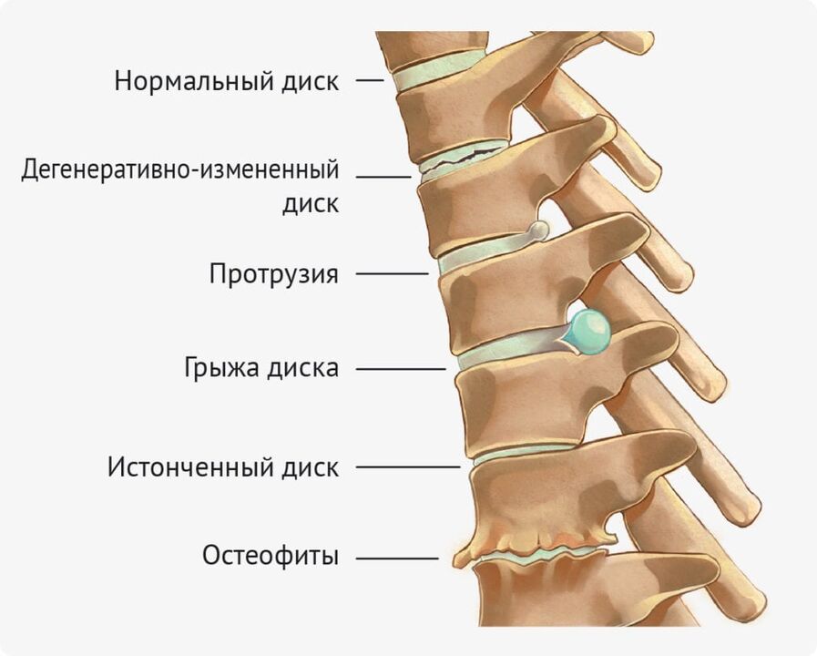 Déformrités de réduction pour l'ostéochondrose Lumbar