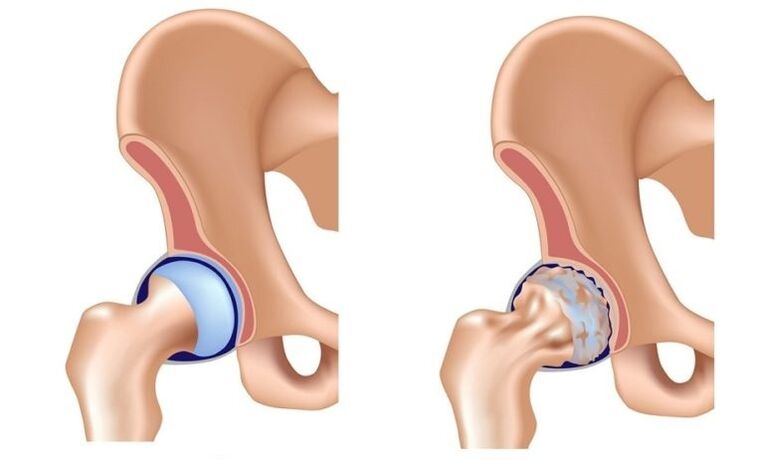 Joint et articulation saines avec arthrose