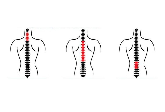 Comment se manifeste l’ostéochondrose 