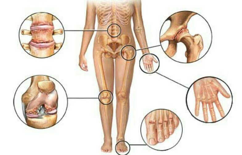 Type et degré d'arthrose