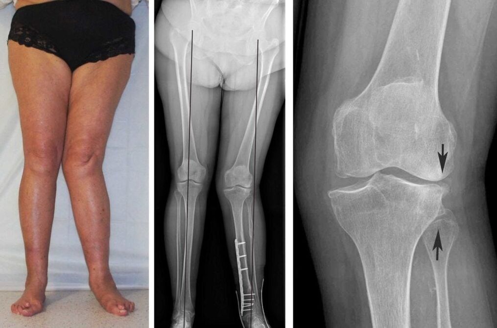 L'arthrose avancée des articulations du genou peut être clairement visible visuellement même sans radiographie