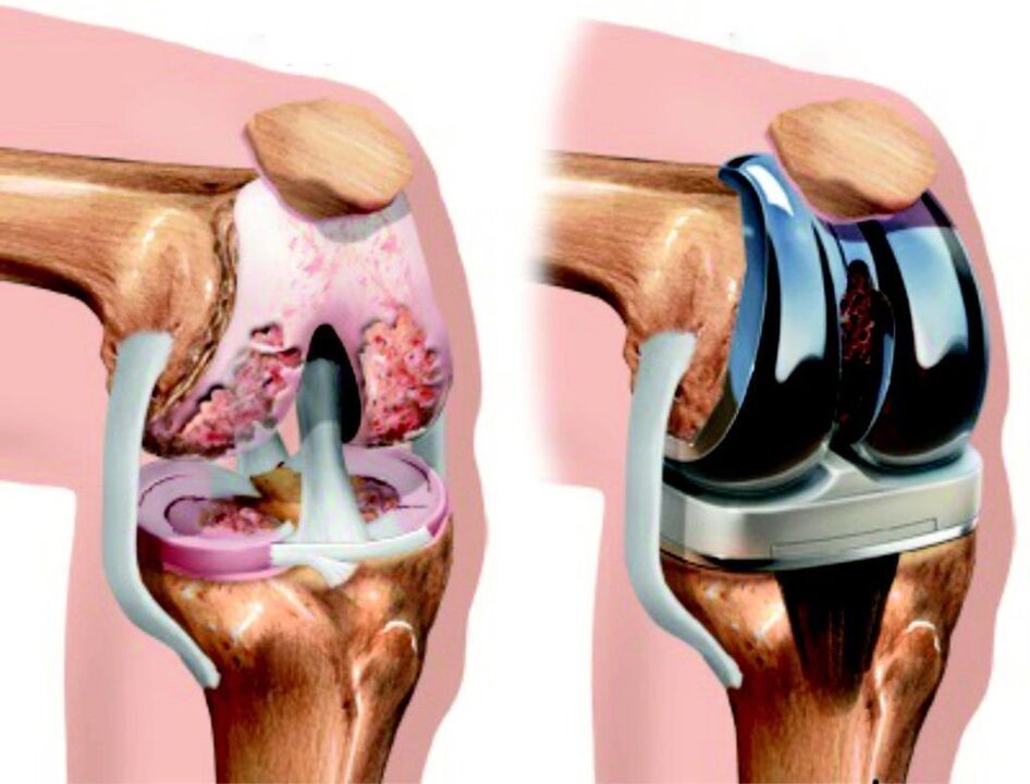 Si l'articulation du genou est complètement endommagée par l'arthrose, elle peut être restaurée à l'aide d'endoprothèses. 