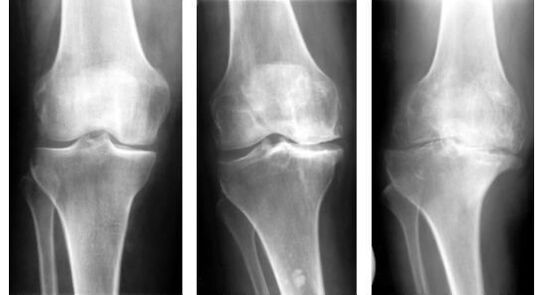 Une mesure diagnostique obligatoire pour déterminer l'arthrose du genou est une radiographie